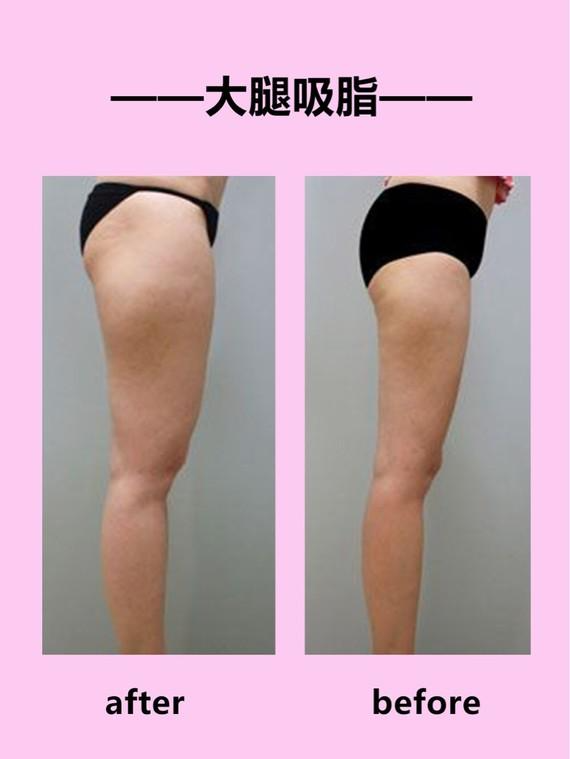 吸脂瘦双腿有效吗 吸脂瘦小腿效果的方法