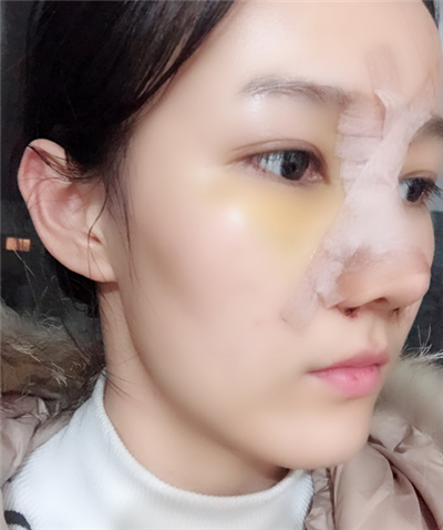 长春中妍医疗美容医院王军隆鼻案例效果分享