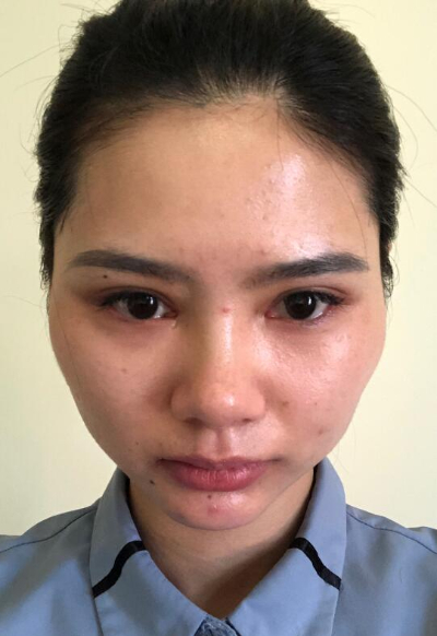 长春亚韩医学美容医院做面部吸脂手术前的脸部