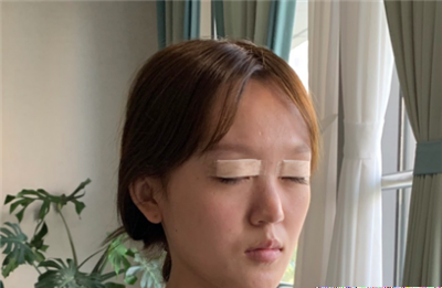 慈溪悦尔医学美容医院赵天宇双眼皮案例效果分享