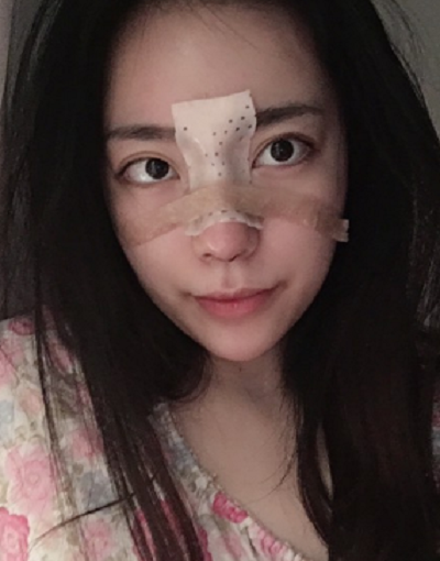 成都汉密尔顿美容医院洪伟鼻修复案例效果分享