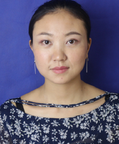 苏州同济医院整形美容中心胡慧敏去眼袋案例效果分享
