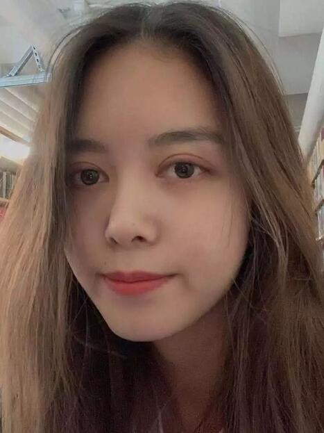 做双眼皮案例，郑州壹加壹王洛生全切双眼皮案例图片
