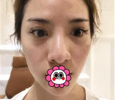 有“鼻王”之称的杨群申做鼻子到底怎么样？隆鼻前后图片