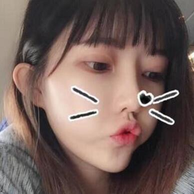 做双眼皮案例，第四军医大学唐都医院李望舟双眼皮案例图片