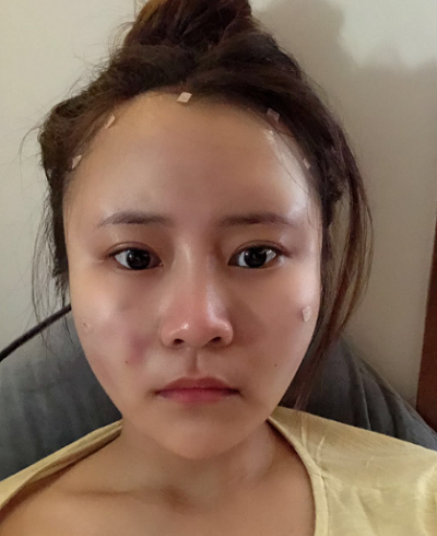 上海美莱医疗美容门诊部白承燦做面部填充案例效果分享