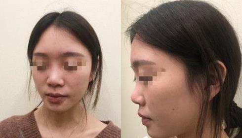 首都医科大学附属北京友谊医院医学美容中心耳软骨隆鼻案例术前效果