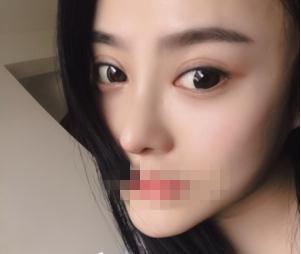 重庆星范整形超体隆鼻一个月效果
