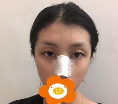 温州韩美周杰群医生耳软骨隆鼻案例分享术后即刻