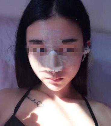 石家庄诺万整形姚华荣硅胶隆鼻案例分享术后两天效果