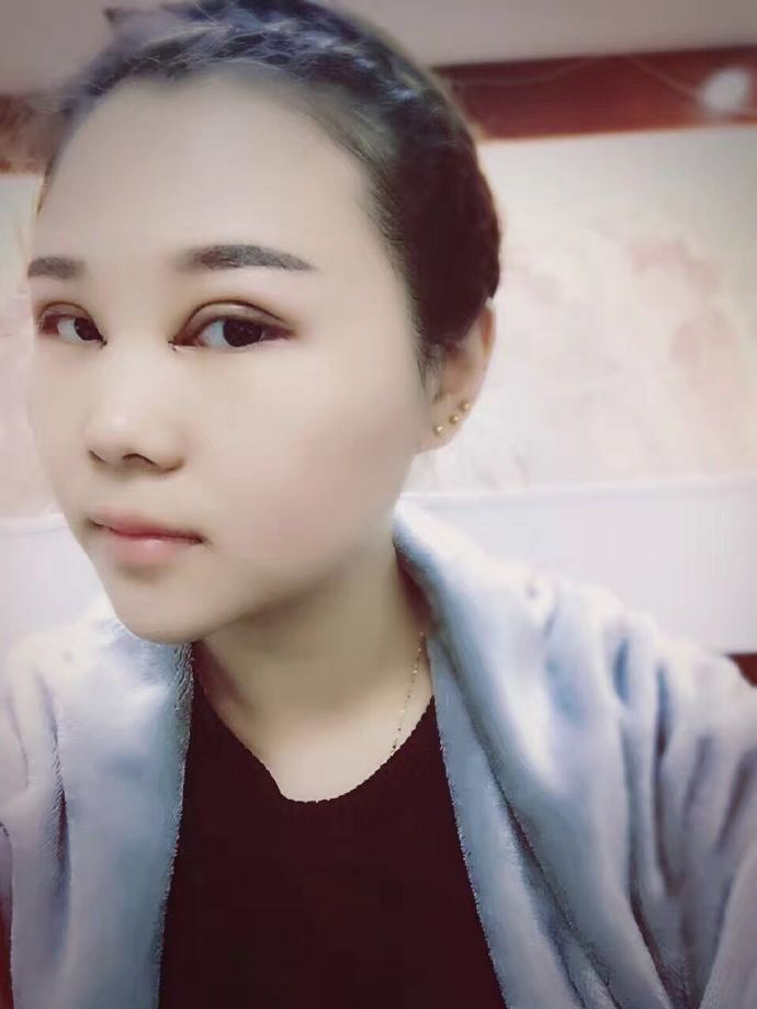 汕头曙光双眼皮一周侧面效果