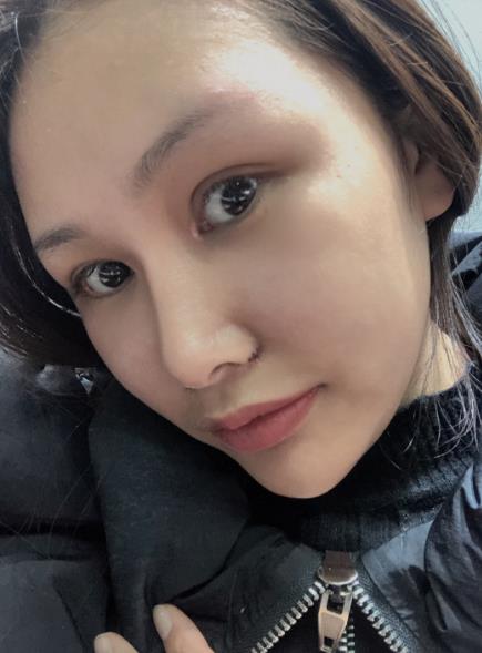 长春中研整形黄帝云鼻头缩小案例术后一个月效果