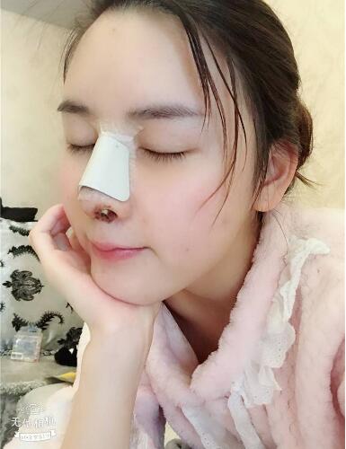 北京艺星整形硅胶假体隆鼻术后第二天侧面效果