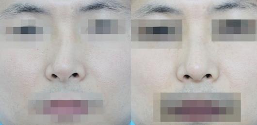 天津时光整形歪鼻矫正案例前后对比图