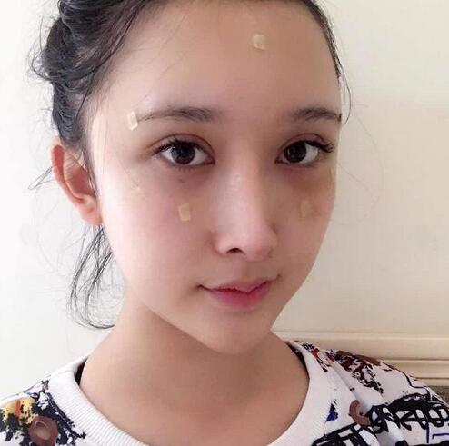 深圳阳光全脸填充术后即刻效果