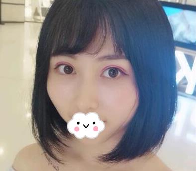 武汉亚太整形双眼皮案例术后两个月效果