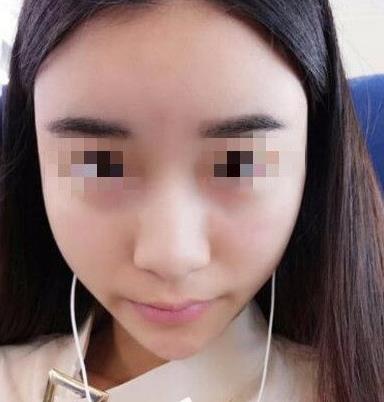 石家庄诺万整形姚华荣硅胶隆鼻案例分享术前效果