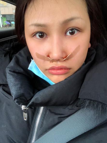 长春中研整形黄帝云鼻头缩小案例术后第二天