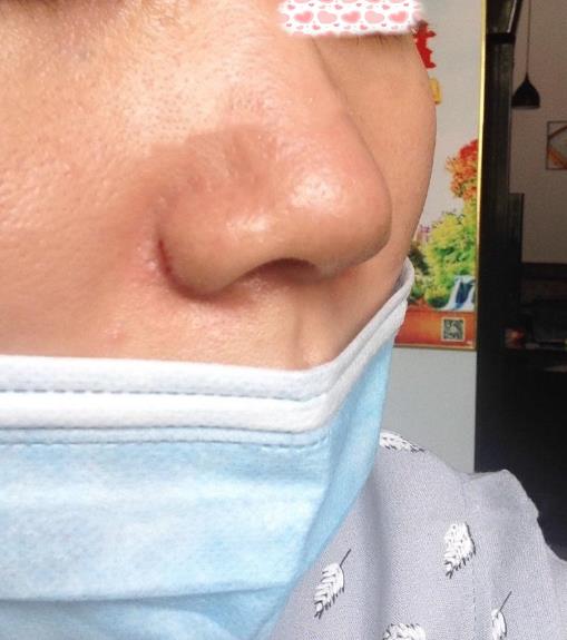 西安米兰柏羽整形手术缩鼻翼案例分享术后一个月效果