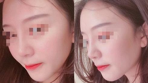 首都医科大学附属北京友谊医院医学美容中心耳软骨隆鼻案例术后三个月效果