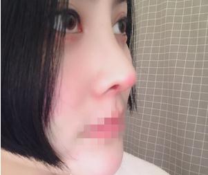 重庆星范整形超体隆鼻半个月效果