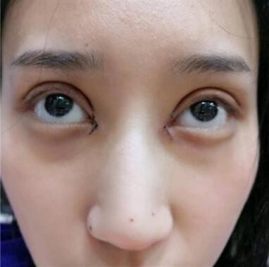 昆明丽都整形双眼皮修复案例术后三天
