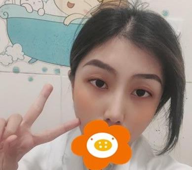 温州韩美周杰群医生耳软骨隆鼻案例分享术后三个月效果