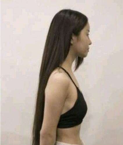 青岛集美蜜桃假体隆胸案例术前效果
