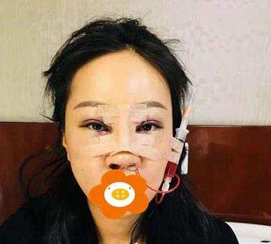 郑州禾丽做肋软骨隆鼻术后两天效果