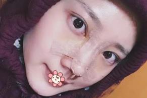 北京彤美耳软骨隆鼻案例分享术后两天效果