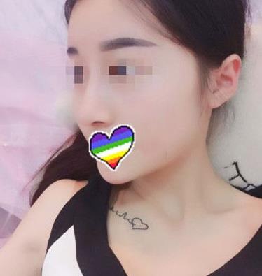 石家庄诺万整形姚华荣硅胶隆鼻案例分享术后一个月效果