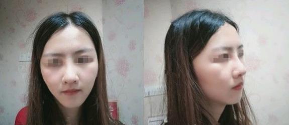 滨州医学院附属医院做隆鼻一个月效果