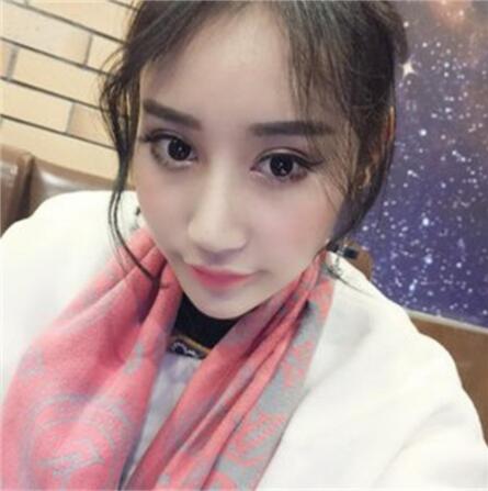 昆明丽都整形双眼皮修复案例术后三个月