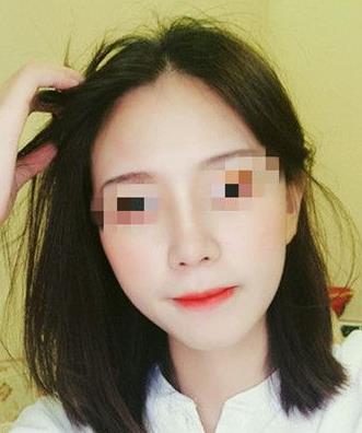 首都医科大学附属北京友谊医院医学美容中心耳软骨隆鼻案例术后一个月效果