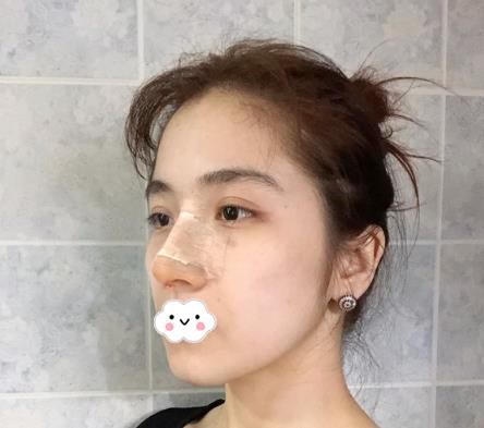 大连沙医生整形付德林做的自体软骨隆鼻术后第二天效果