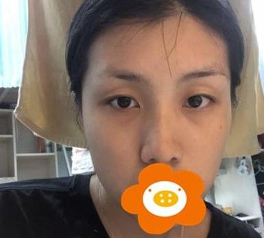 温州韩美周杰群医生耳软骨隆鼻案例分享术前效果