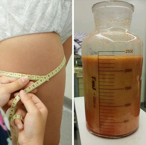 成都赵博士整形大腿吸脂案例吸脂量