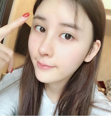 兰州美月做膨体隆鼻术后两个月效果
