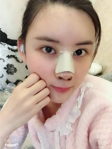 兰州美月做膨体隆鼻术后第二天