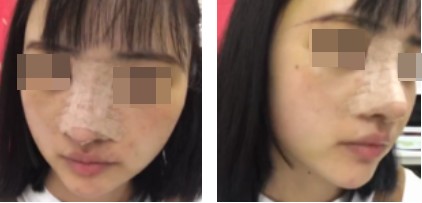 哈尔滨成美整形周小生鼻综合案例术后两天