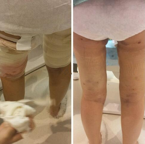 成都赵博士整形大腿吸脂案例术后即刻效果