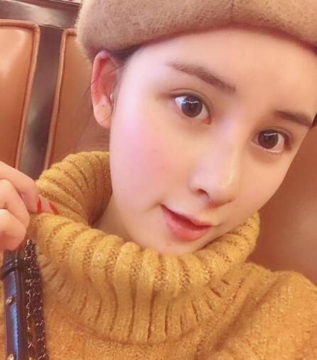 兰州美月做膨体隆鼻术后一个月效果