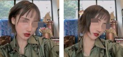 哈尔滨成美整形周小生鼻综合案例术后两个月