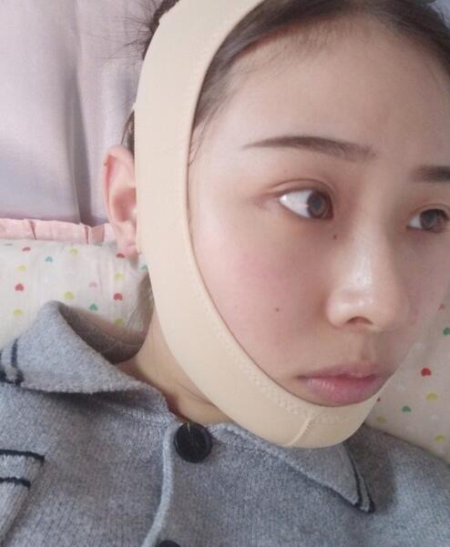 杭州时光磨骨案例术后一个月效果