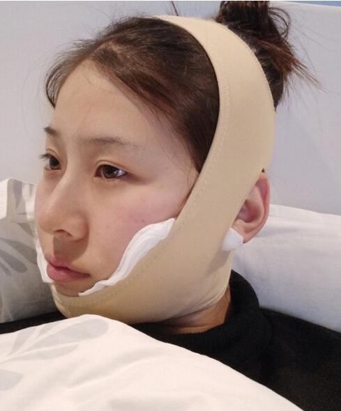 杭州时光磨骨案例术后一周效果
