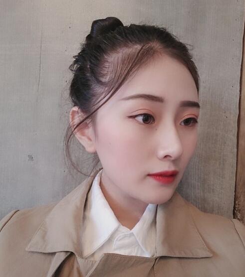杭州时光磨骨案例术后三个月效果