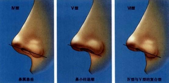 鼻小柱延长术一般价位多少钱？做鼻小柱延长术有什么不好的影响吗？