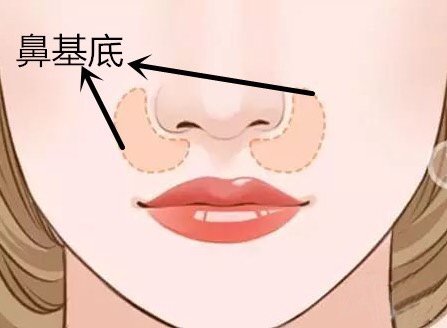 做玻尿酸垫鼻基底风险有哪些？深圳市玻尿酸丰鼻基底大概需要费用？