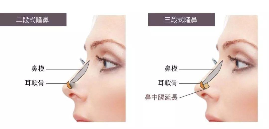 自体软骨隆鼻的手术优缺点有哪些?肋软骨填充鼻基底多久能自然?