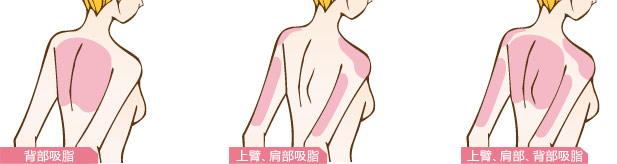 超声溶脂瘦肩部为什么没有效果  超声溶脂瘦肩部有缺点吗 